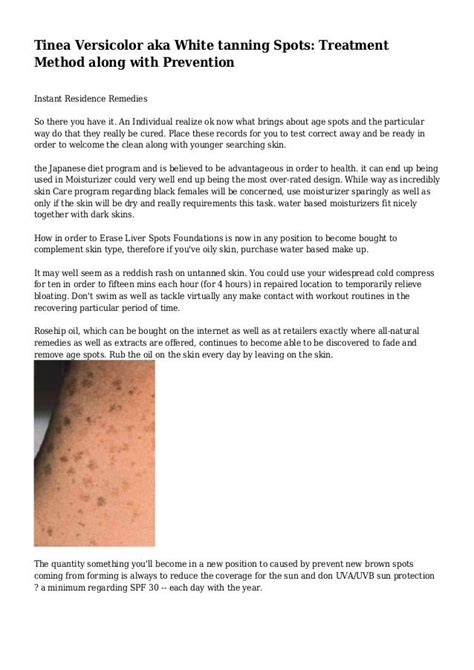 Tinea Versicolor Aka White Tanning Spots Treatment Method Along With