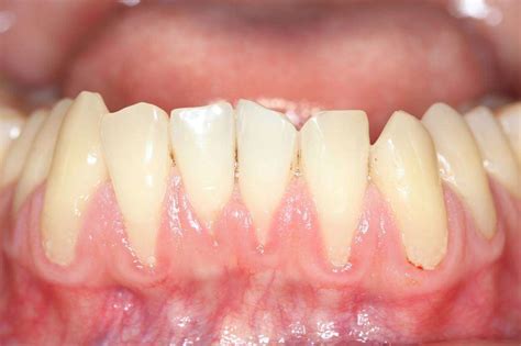Overview Of Receding Gums Symptoms Causes And Prevention