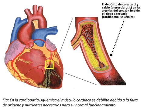 A Fisiopatologia Da Cardiopatia Isquêmica Envolve Especificamente Dois Processos