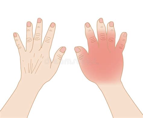 Right Hand Swollen Infection Sting Allergy Injury In Comparison To The