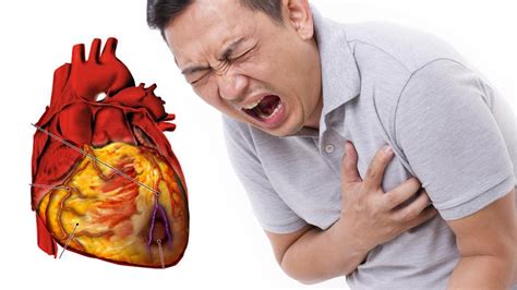 Heart Attack And Cardiac Arrest Differences You Must Know Youtube