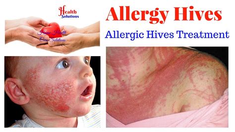 Allergy Hives Allergic Hives Treatment Youtube