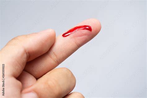 Bleeding Blood From The Cut Finger Wound Injured Finger With Bleeding