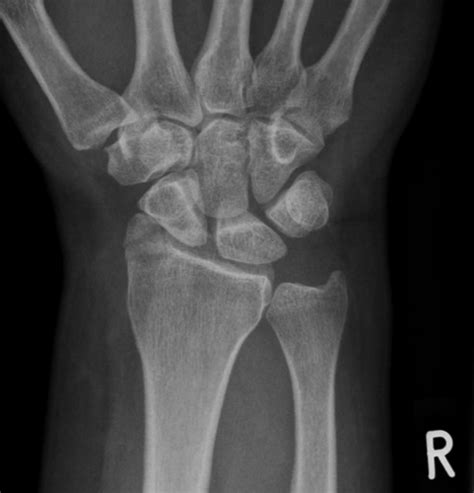 An Intra Articular Fracture Of The Radial Styloid Process Is