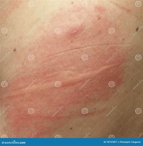 Rash On Sensitive Skin Stock Image Image Of Itchy People 78197897