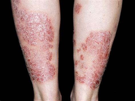 Improving Patient Management In Psoriasis Focus On A Comprehensive