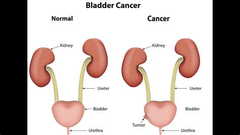 I have symptoms of uti.discomfort when passing water. Bladder cancer | Bladder infection symptoms | Chemotherapy ...