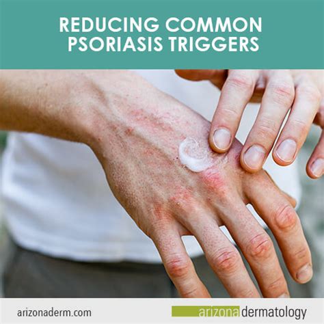 Reducing Common Psoriasis Triggers