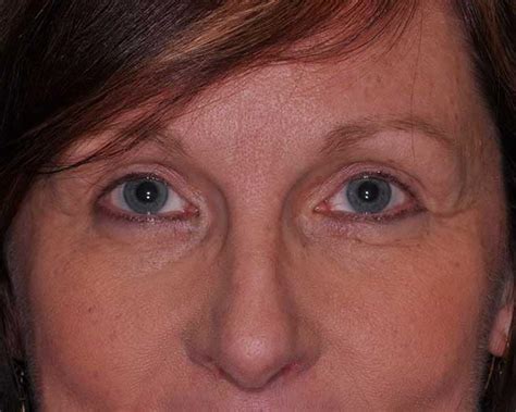 Upper Eyelid Surgery In Mo Upper Blepharoplasty In St Louis