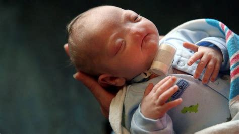 Alabama Baby Born Without A Nose Mom Says Hes Perfect Abc News