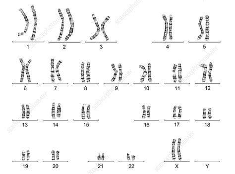 Human Female Karyotype Stock Image C0166742 Science Photo Library