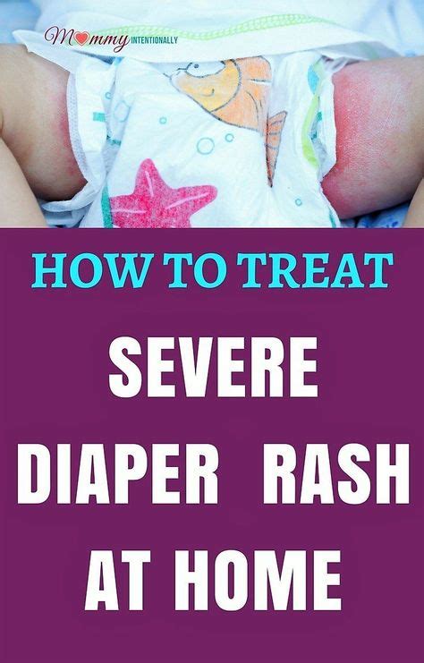 Most Effective Ways Of Treating Diaper Rash In Babies Diaper Rash Treating Diaper Rash Good