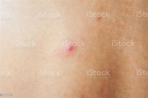 Acne With Red Spots On The Back Stock Photo Download Image Now Istock