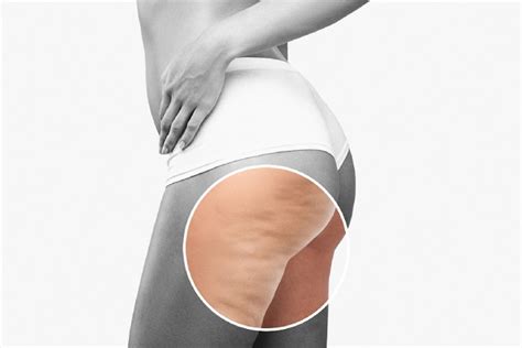 say goodbye to cellulite with these effective ways lynn aesthetic