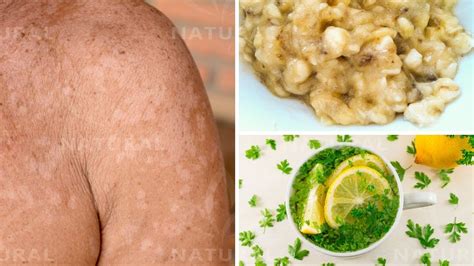 3 Natural Remedies For Treating Tinea Versicolor At Home Pityriasis