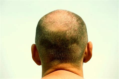 Bulk Hair Follicle Germ Growth Holds Promise For Treating Baldness