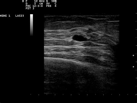 A A Simple Breast Cyst 75 B Breast Ultrasound Showing A Cancer Images