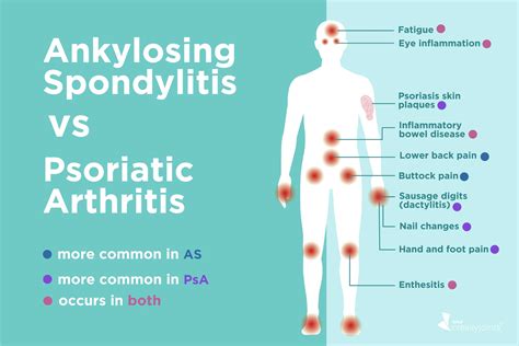 Difference Between Ankylosing Spondylitis And Rheumatoid Arthritis