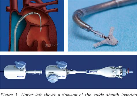 Figure 1 From Percutaneous Mitral Valve Edge To Edge Repair With The