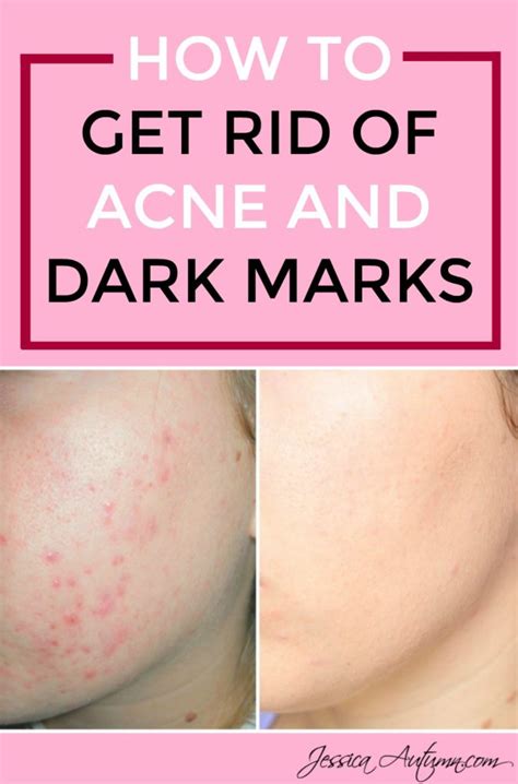 How To Get Rid Of Acne And Dark Marks