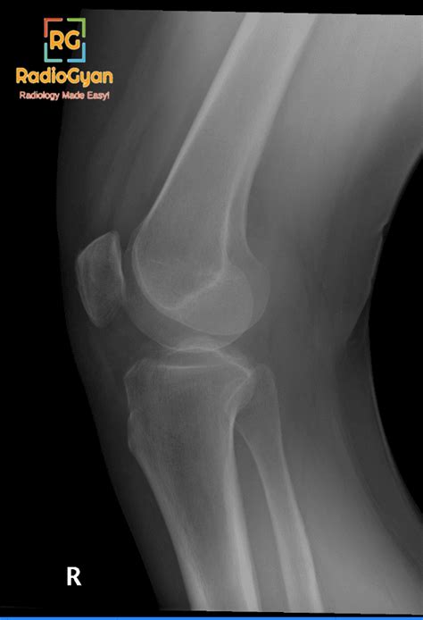 Tibial Plateau Fracture Radiology Cases Radiogyan