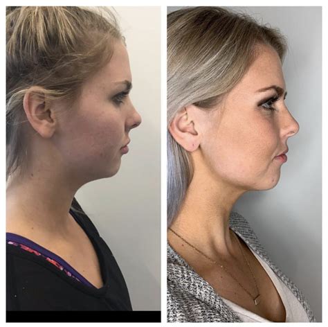 Kybella Injections In Gilbert Colair Beauty Lounge