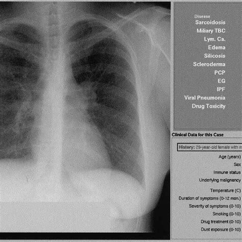 Demonstration Of A Chest Radiograph Of Interstitial Lung Disease Viral
