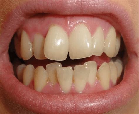 Lassen sie sich von fachärzten bei dermacare ausführlich beraten und erfahren sie wie ihre erfolgsaussichten für die. Invisalign vorher/nachher: 5 Ergebnisse mit unsichtbaren ...