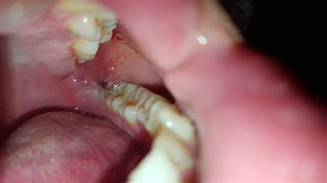 A Question About Healing Process From Wisdom Tooth