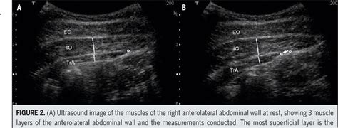 Ultrasound Imaging Assessment Of Abdominal Muscle Function During