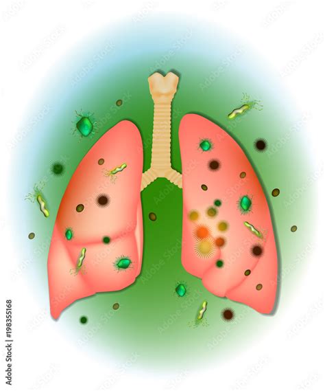 Viral Lung Infections Influenza Virus Particles Entering The Lungs