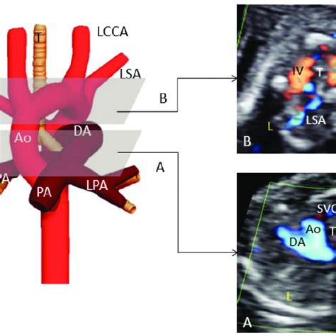 Fetal Transverse Views In A Case Of A Left Aortic Arch With An Aberrant