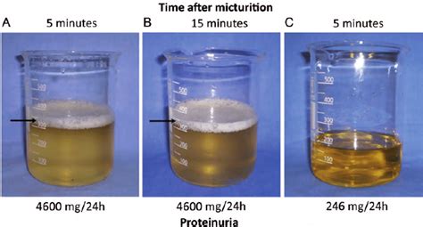 Prolonged Foamy Urine 5 Minutes A And 15 Minutes B After