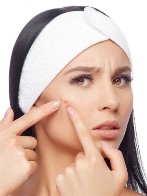 How To Get Rid Of Acnepimples Overnight Hacks To Get Rid Of Acne