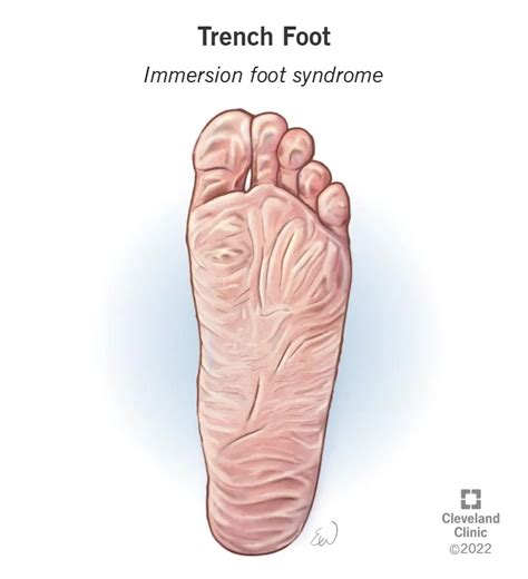 Trench Foot Causes Symptoms Treatment And Prevention