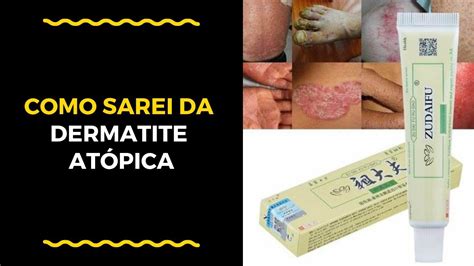Como Tratar Dermatite Psoriase Com Pomada Natural 2019 Youtube