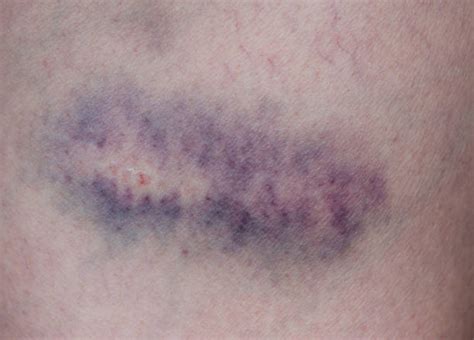 Hematoma Thigh Stock Photos Pictures And Royalty Free Images Istock