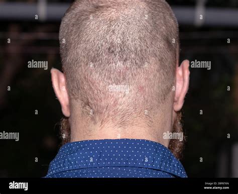 Shaved Head Bumps Telegraph