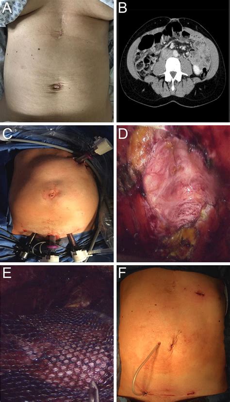 Treatment Of Patient With Incisional Hernia With Laparoscopic Sublay