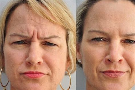 Botox For Wrinkles Westerwood Health Clinic