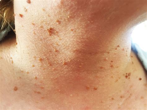 Bumps On Your Skin That Are Totally NormalAnd You Shouldn T Pop Pulse Nigeria