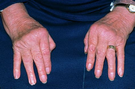 Rheumatoid Arthritis Of Hands With Ulnar Deviation Photograph By