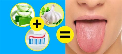 10 Ways To Get Rid Of White Tongue And Make It Healthier Oral Thrush