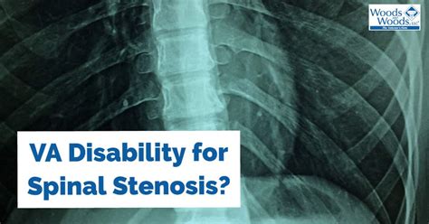 Va Disability For Spinal Stenosis Can Be Easily