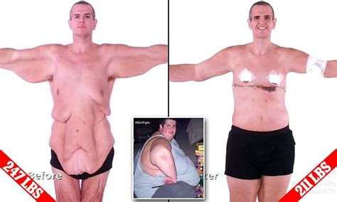 Man Shows Off His 479lb Weight Loss After Having Skin Removed Daily