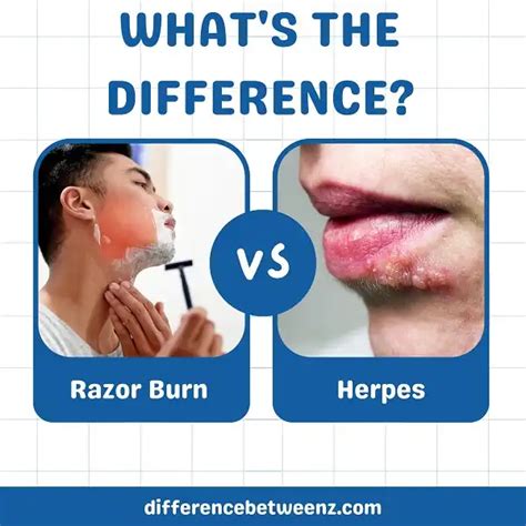 Difference Between Razor Burn And Herpes Difference Betweenz