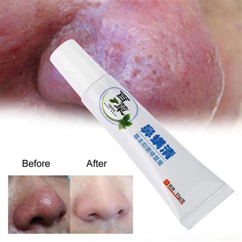 15g Rosacea Treatment Cream Nose Redness Removal Cleaning Antibacterial