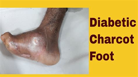 Diabetic Charcot Foot Deformity Diabetic Neuropathy And Foot