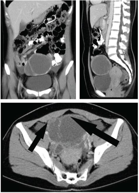 Ct Scan Through The Abdominal Shows A Mature Cystic Teratoma In The