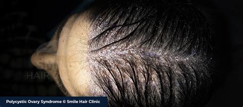 Polycystic Ovary Syndrome Pcos Hair Loss Smile Hair Clinic